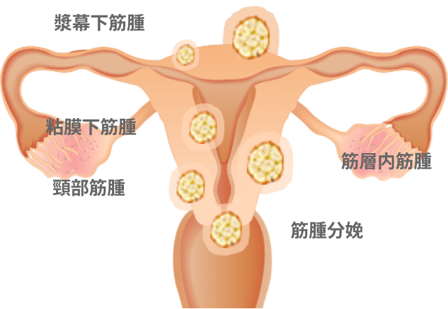 子宮筋腫・子宮内膜症・ポリープについて