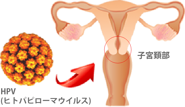 子宮頸がんの原因